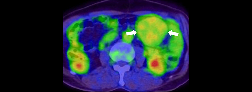 image of slow progression tumor