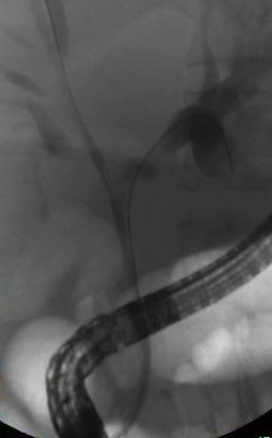 Pancreatic Stent