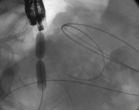 Pancreatic duct stone