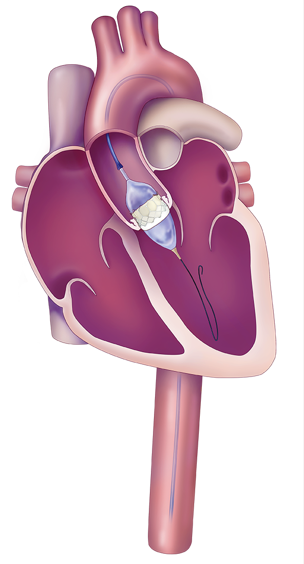 cardio-tavr-commander-tf-step2