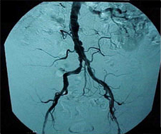 x-ray of vein