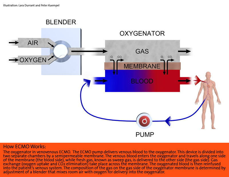 how_ecmo_works_lg.jpg