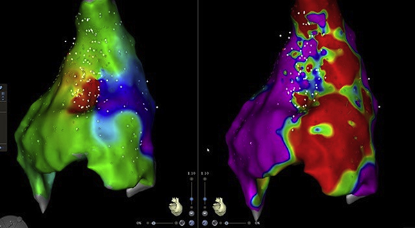 image of activation sequence map (left) and voltage map (right)