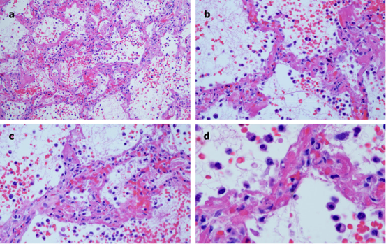 images of microscopic features of pulmonary autopsy samples