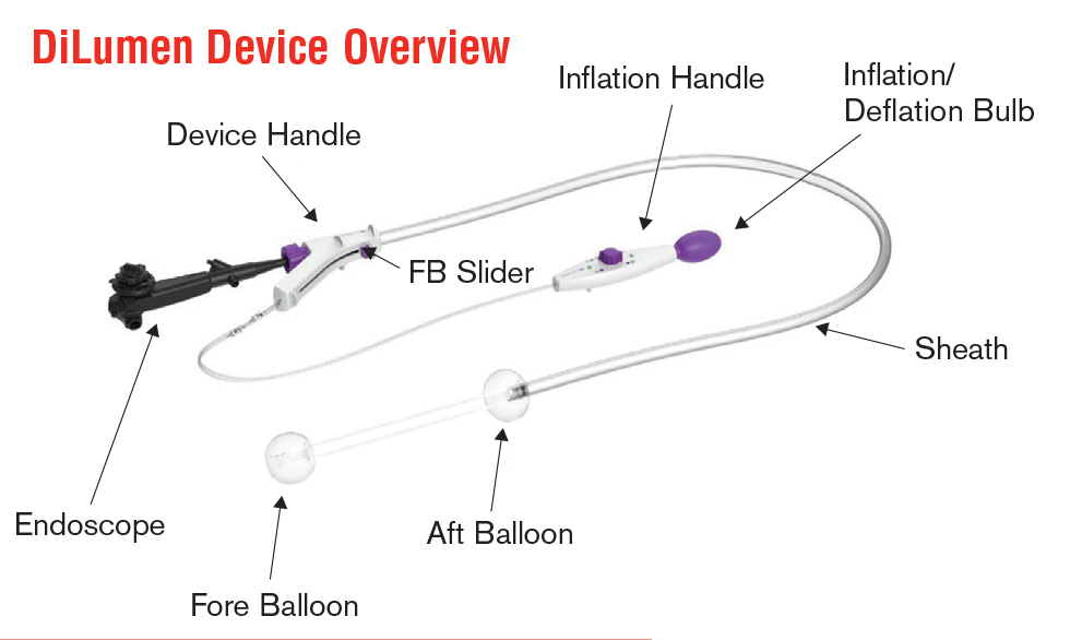 Dilumen device overview