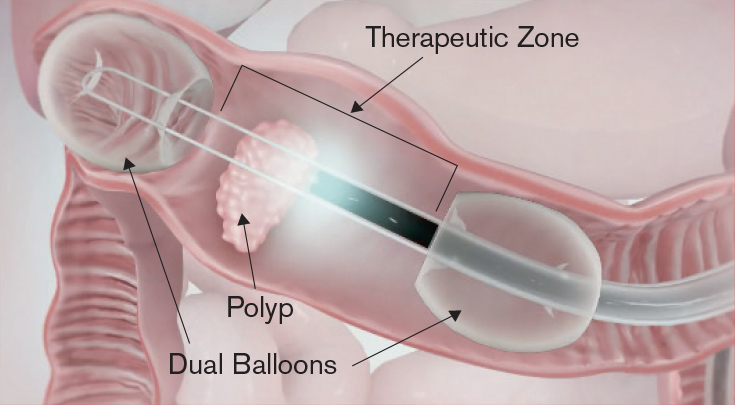 The endolumenal approach