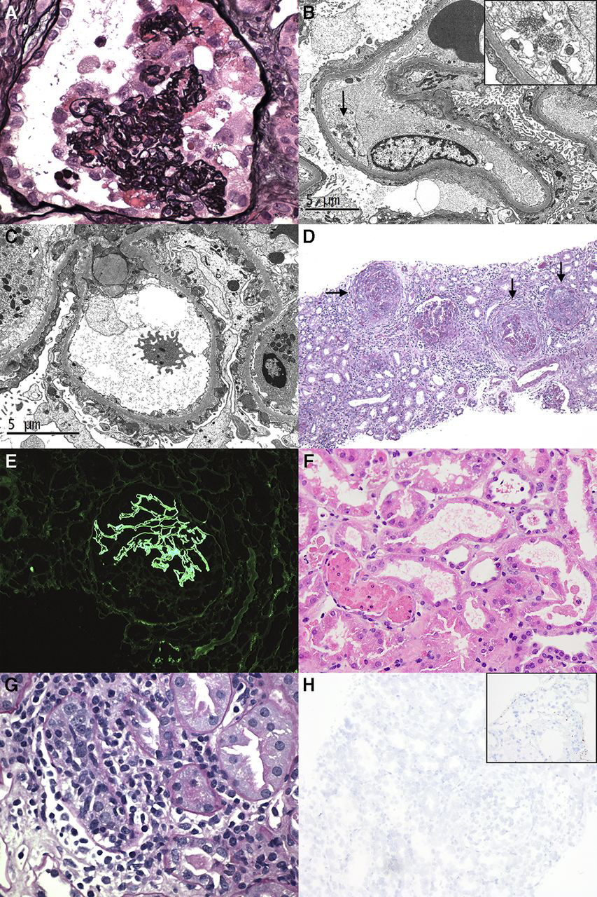 images of kidney biopsies