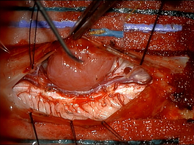 image of Cervical spine meningioma