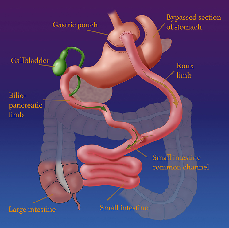 bariatric surgery bypass