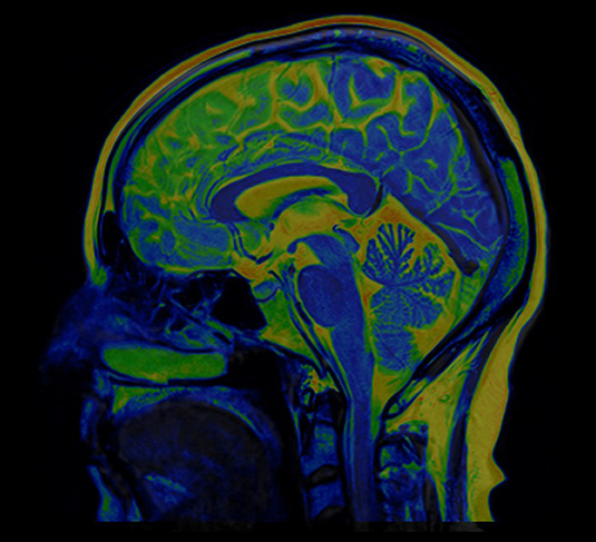 MRI brain scan