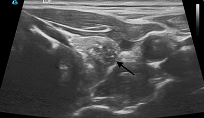 ultrasound of thyroid