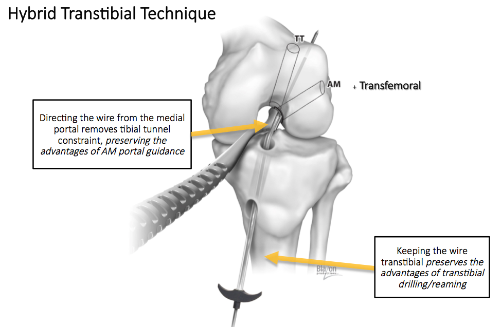 Diagram of the Hybrid Transtibial Technique