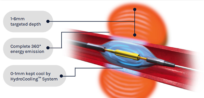 Diagram of Paradise Renal Denervation System