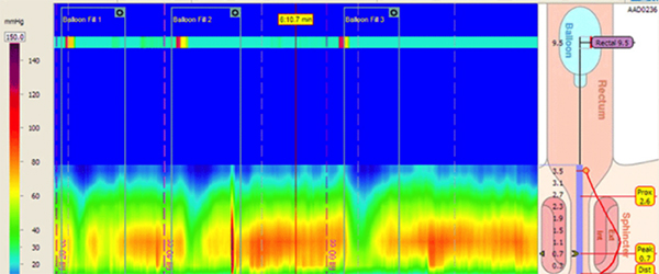 image of a 3D anorectal manometry