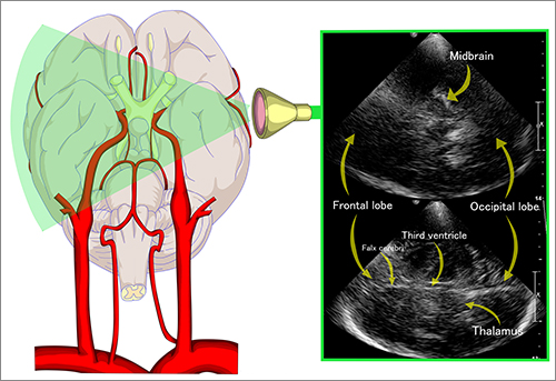 Transcranial dopler sonography