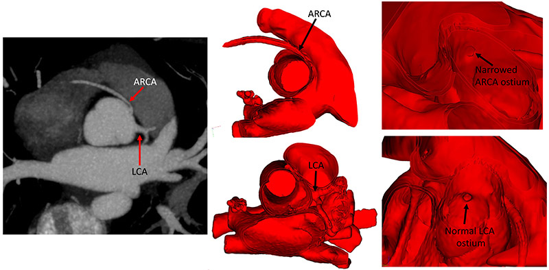 CT imgaes scans of arteries