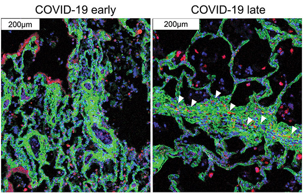 image of lung cells damaged by COVID-19 undergoing analysis