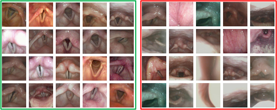 Various pictures of patients vocal folds