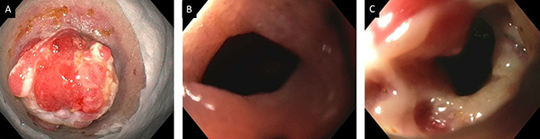 Assessment of disease activity of Crohn’s disease in patients with ileostomy.