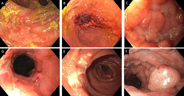 Inflammatory disorders of the pouch