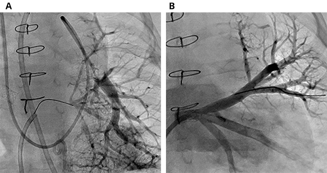 Before and after treatment angiograms showing left pulmonary vein network