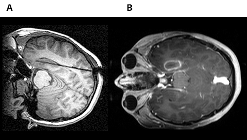 image of mri scans of the brain