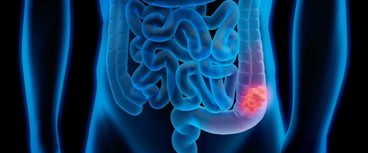 Dr. Felice Schnoll-Sussman, a gastroenterologist and the director of The Jay Monahan Center for Gastrointestinal Health, explains what to expect before, during, and after a colonoscopy.