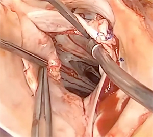 surgery using the HAART ring on a 22-year-old male with bicuspid valve with a moderate to severe aortic insufficiency and root aneurysm