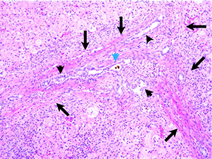 image of a Pre-operative liver biopsy