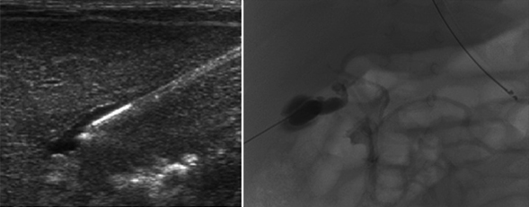 image of Percutaneous cholangiogram