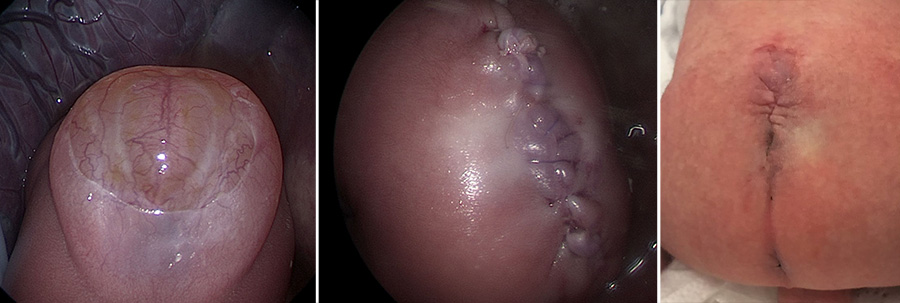 images of fetoscopic surgical repair