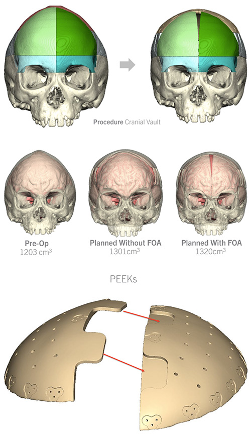 image of Virtual Surgical Planning for Cranial Vault Remodeling