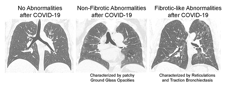 image of CT scan of lung following COVID-19 with and without abnormalities