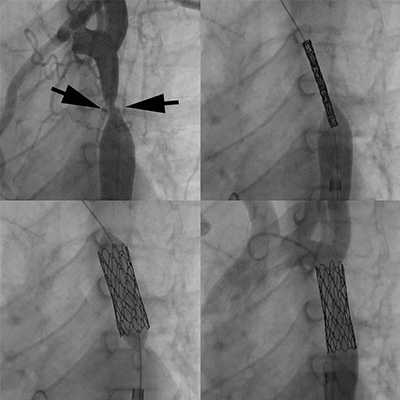 xray images of tight coarctation with CP Stent