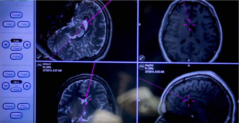 Endoscopy images during colloid cyst surgery