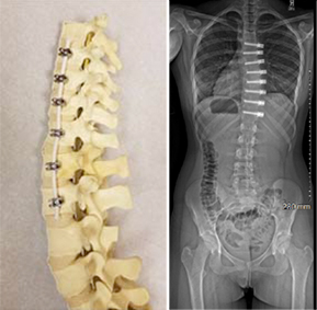 image of VTB hardwares with post-op xrays