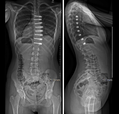 Postoperative radiology images for tethering