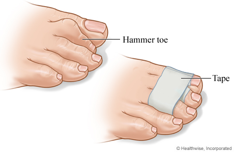 diagram of hammer toe