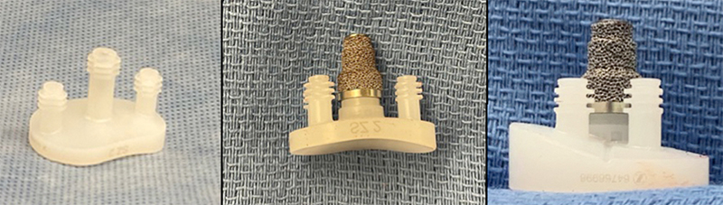 image of Alliance Glenoid system pegs