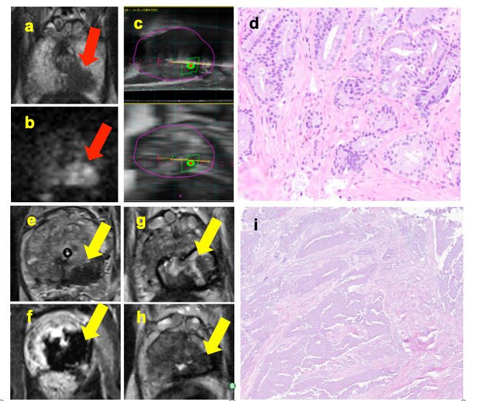 Collage of photos displaying prostate cancer MRI results