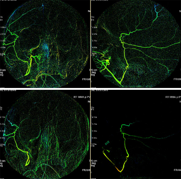 reconstructed angiograms of a patient who received embolization of the middle meningeal artery