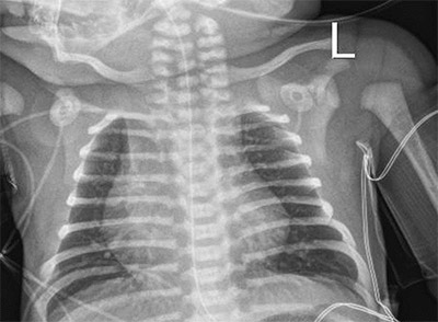 chest xray image of full-term newborn