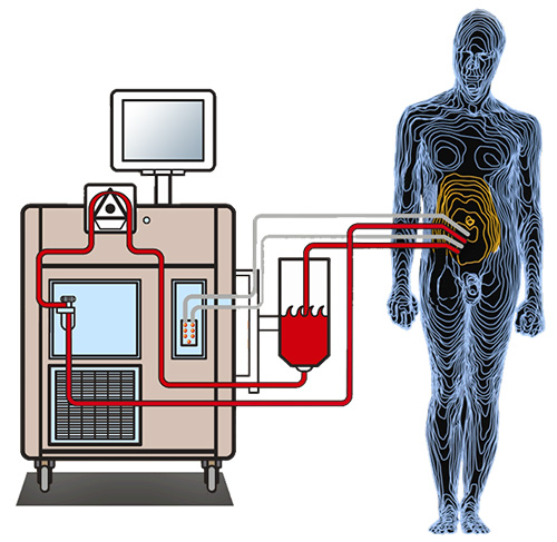 HIPEC graphic