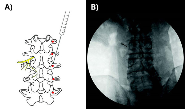 image of X-ray guided dorsal ramus block (XDRB) injection