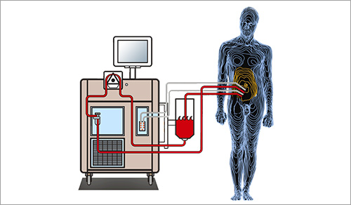 NewYork-Presbyterian Offers Innovative Approach to Treating Cancer in the Peritoneal Cavity