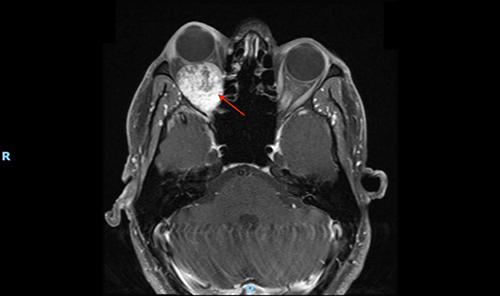 image of scan showing benign right orbital tumor