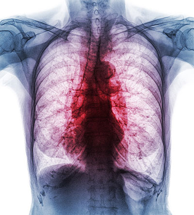 chest xray image of inflamed lungs