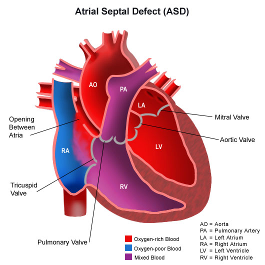 An Artist’s depiction of Atrial Septal Defect