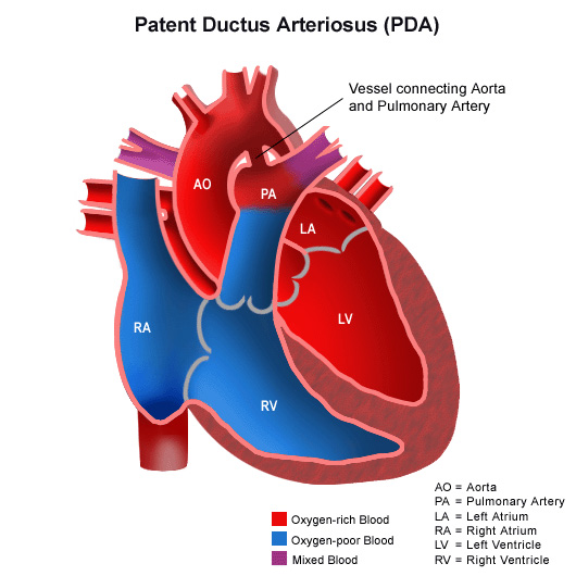 An artist’s depiction of Patent Ductus Arteriosus