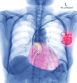 advances-cardiac-2023-05-xray-of-cied